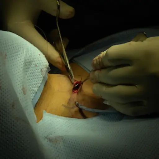 外科医生在颈部手术后缝合。