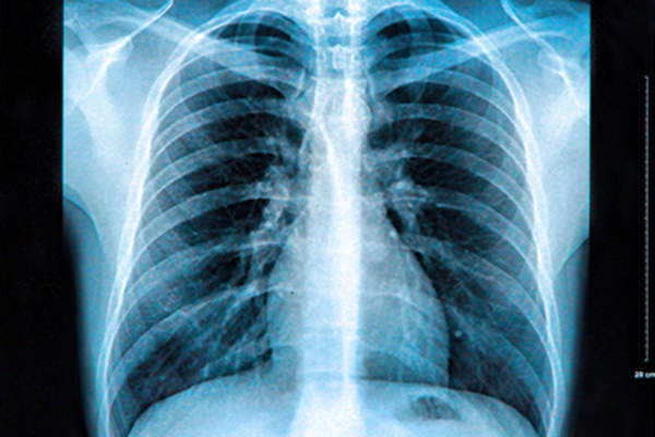 胸部X射线。