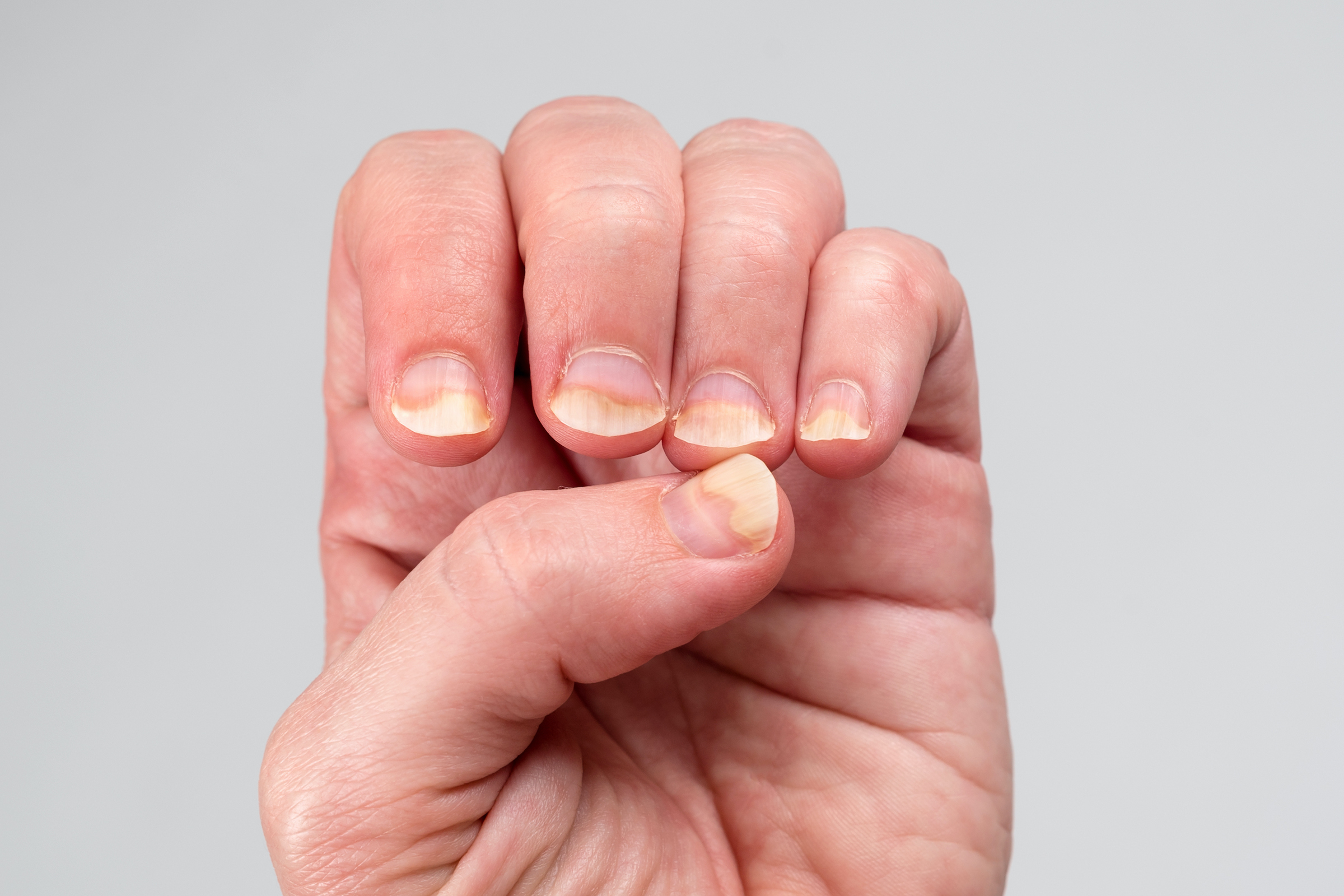 How Psoriatic Arthritis Affects Your Nails