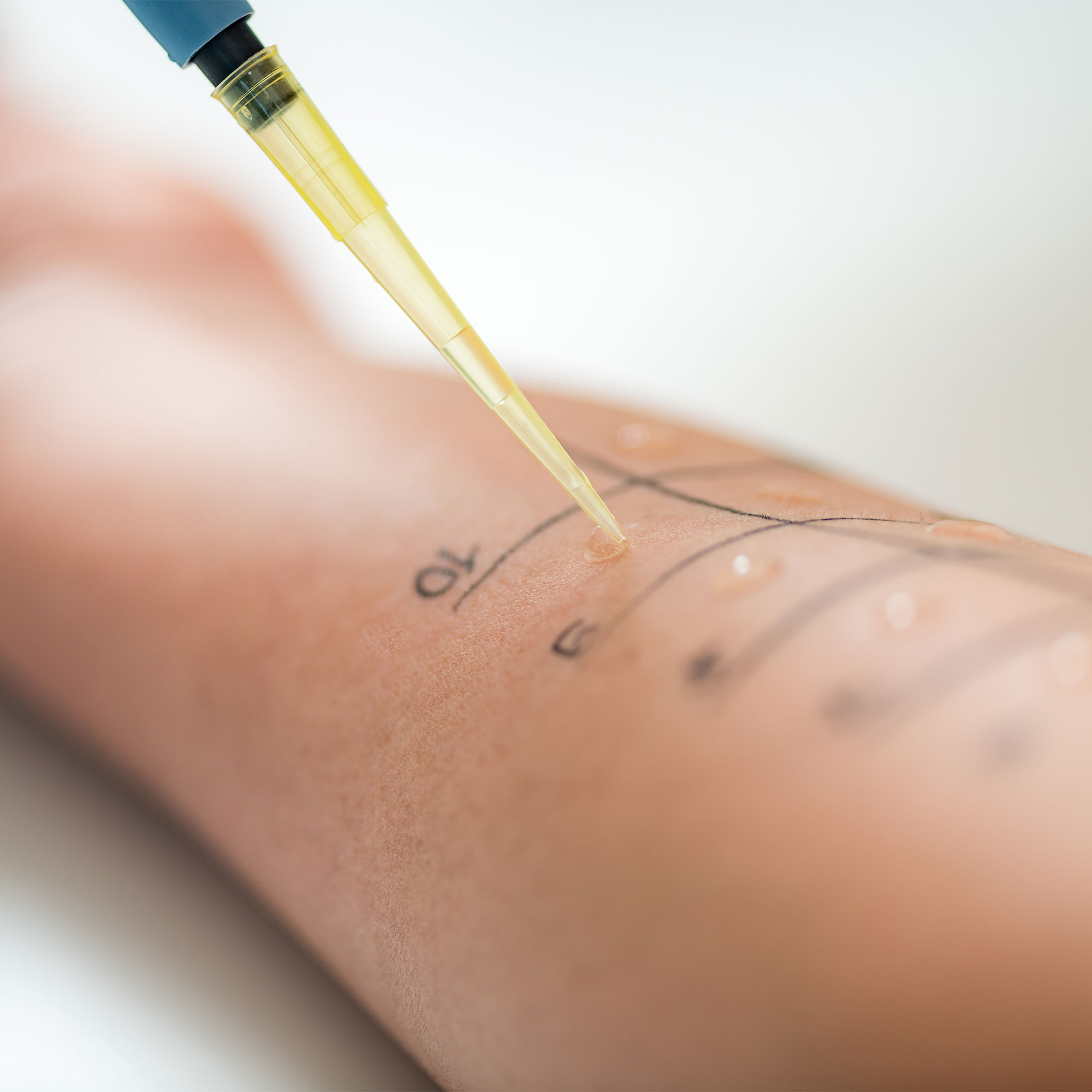 一个特写镜头的人得到一个胳膊过敏皮肤针刺试验