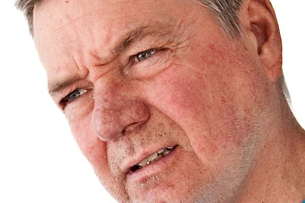 Rhinophyma