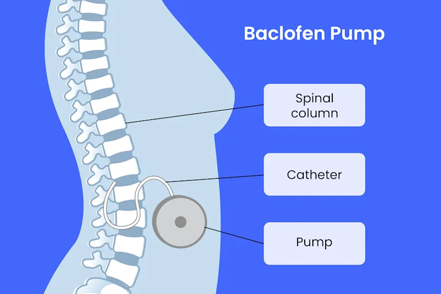 https://www.healthcentral.com/condition/multiple-sclerosis/intrathecal-baclofen-pump