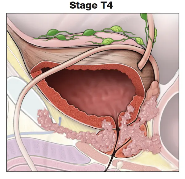 了解前列腺癌的肿瘤分期- t4 -前列腺期