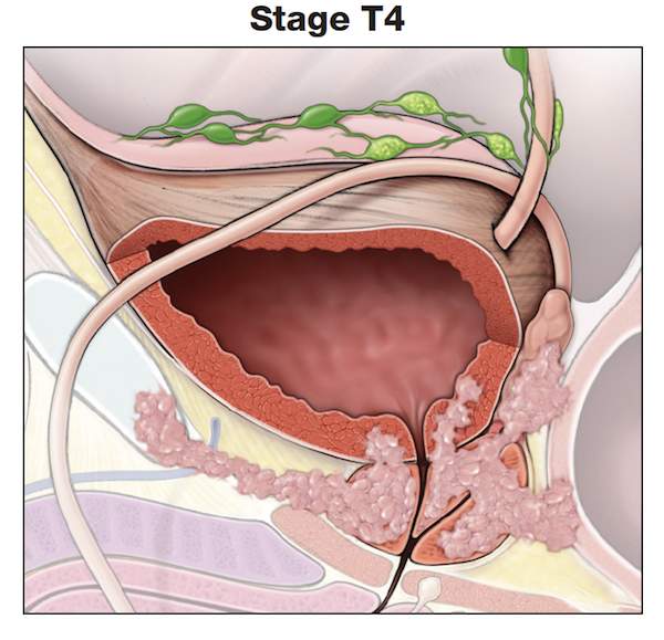 理解前列腺癌肿瘤分期- t4期前列腺癌