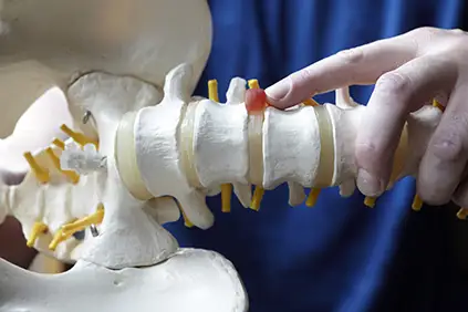 脊柱解剖模型上的椎间盘突出。
