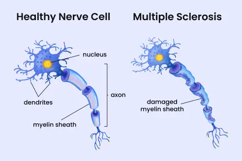 How Multiple Sclerosis (MS) Affects the Myelin Shealth