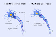 Ms Multiple Sclerosis Information YRHWH Ms Multiple Sclerosis Information YRHWH