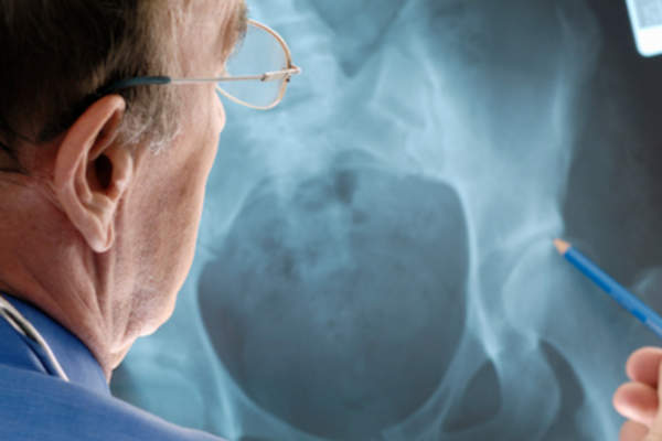 医生检查髋部骨质疏松症的x光片。