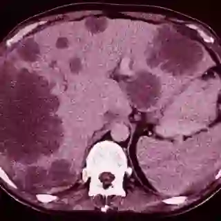 CT scan of liver tumors