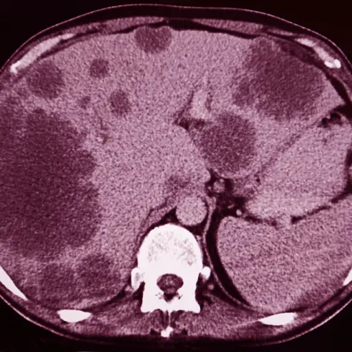 CT扫描肝脏肿瘤