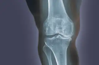 Ask the doctor: Braces for knee arthritis - Harvard Health