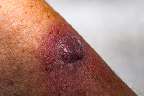 Kaposi's sarcoma