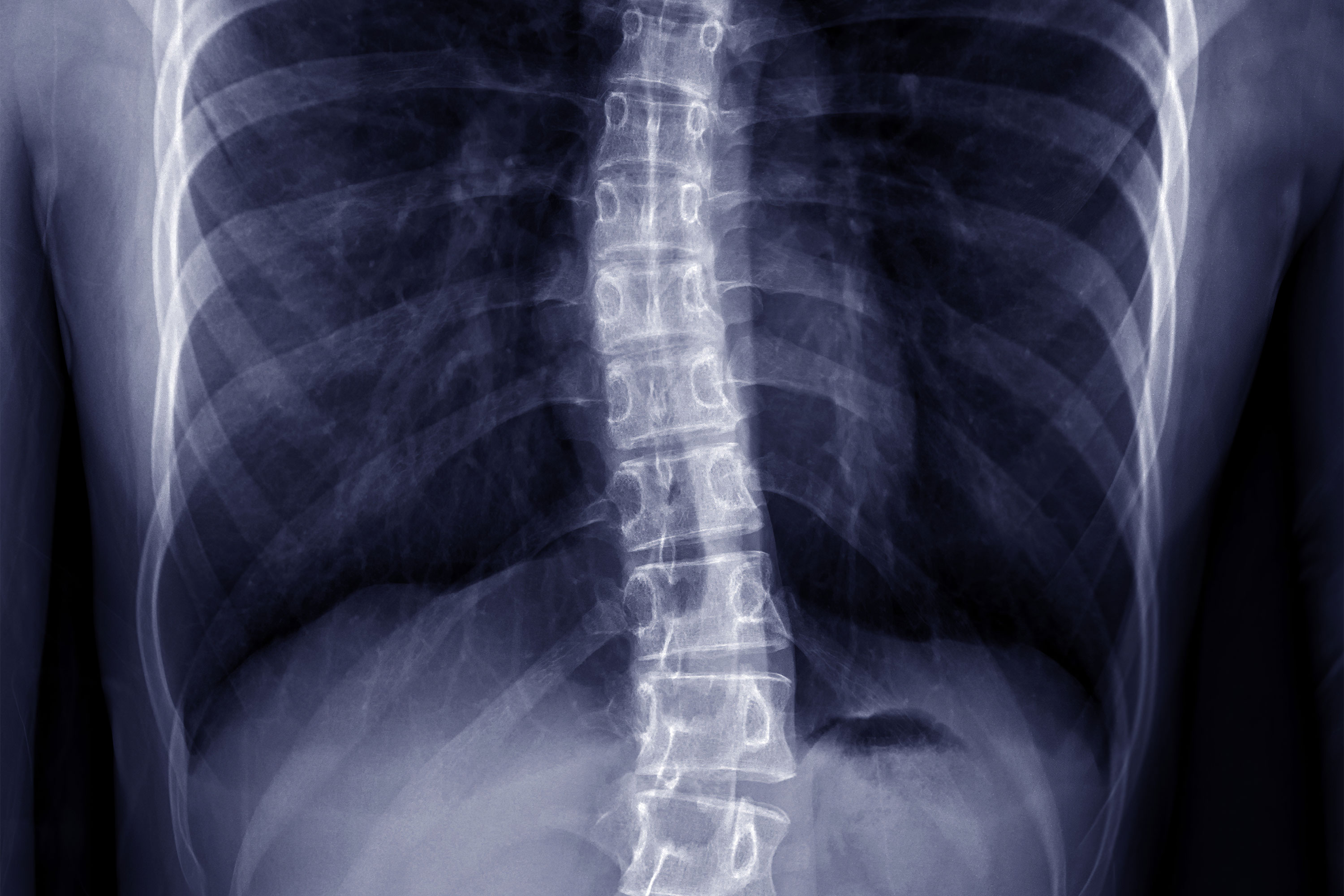 All About 'S'-Shaped Scoliosis