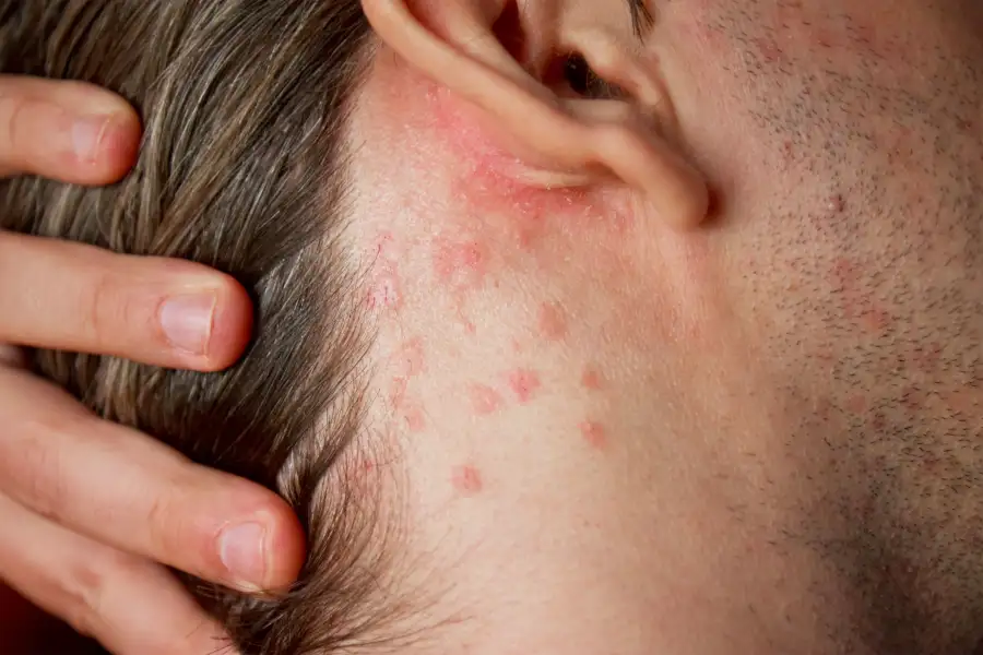 Skin Rash Leads to Shocking Diagnosis 