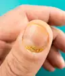 指甲牛皮癣