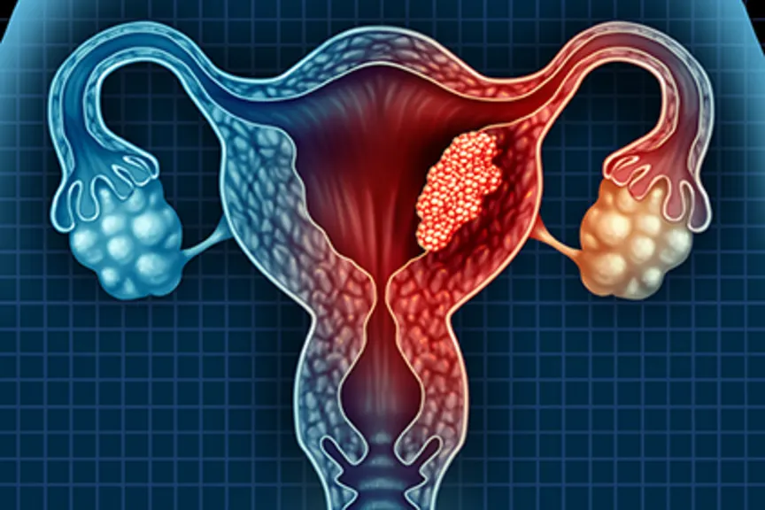 子宫内膜癌的形象。