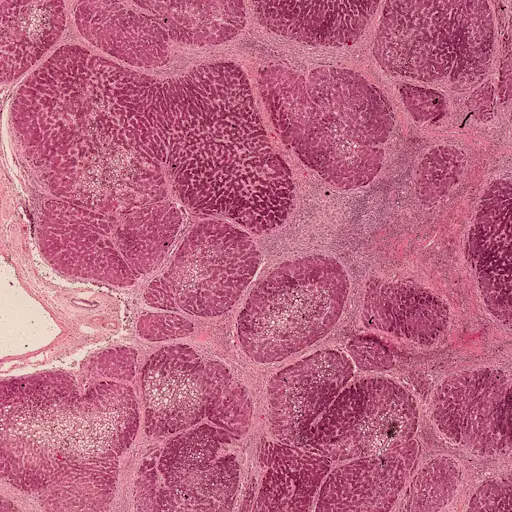 显微镜下的肝硬化