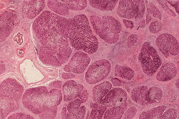 在显微镜下肝硬化