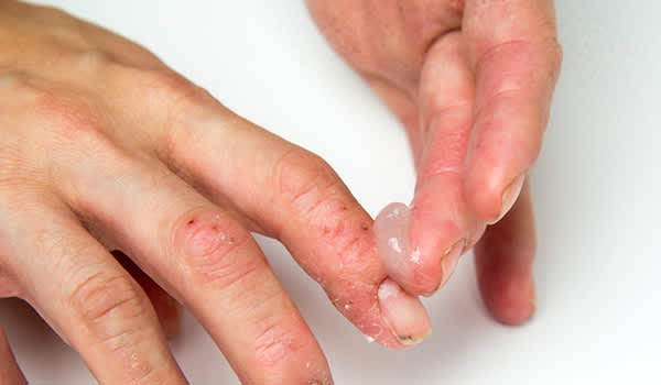 男士用药膏治疗手指湿疹。