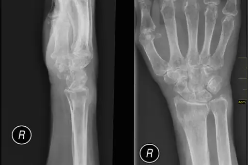 骨质疏松症手和手腕。医用X射线