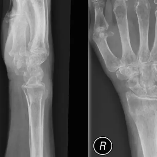 骨质疏松症手和手腕。医用X射线