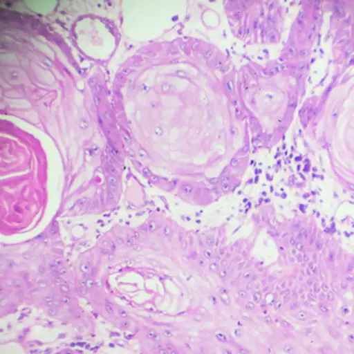 显微镜下的鳞状细胞癌。