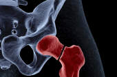 osteoporosis hip