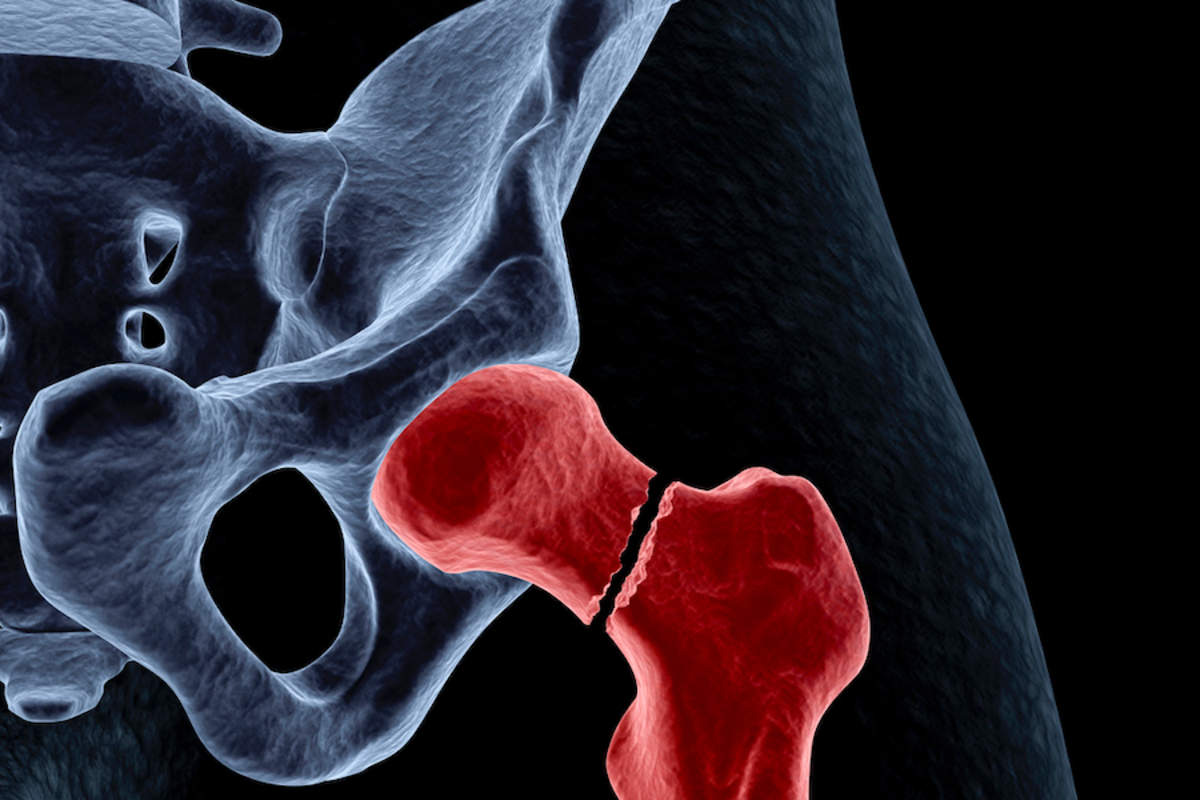 Bone Fractures: Types, Causes, and Treatments