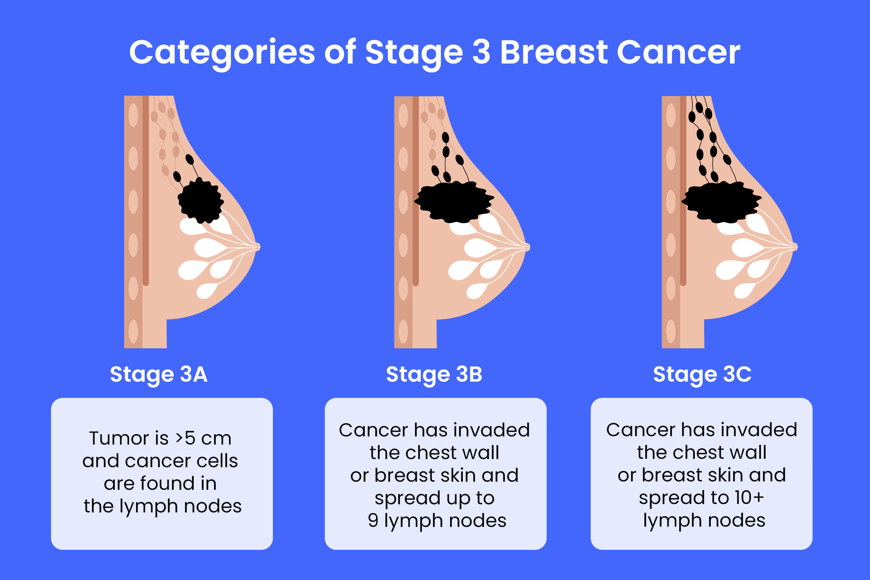 Stage 20 Breast Cancer Symptoms, Treatment, and Survival Rate