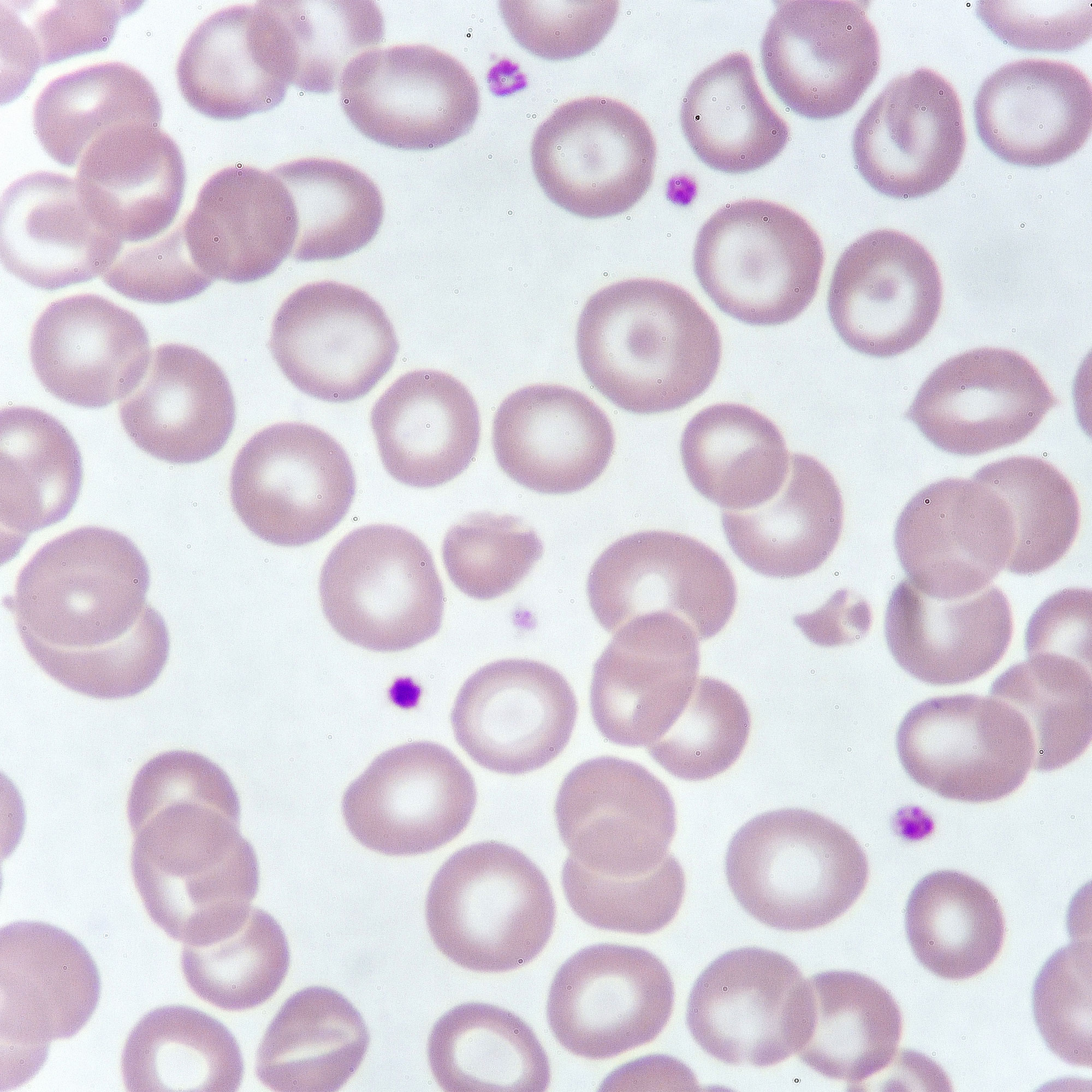 贫血病人红细胞的显微镜视图