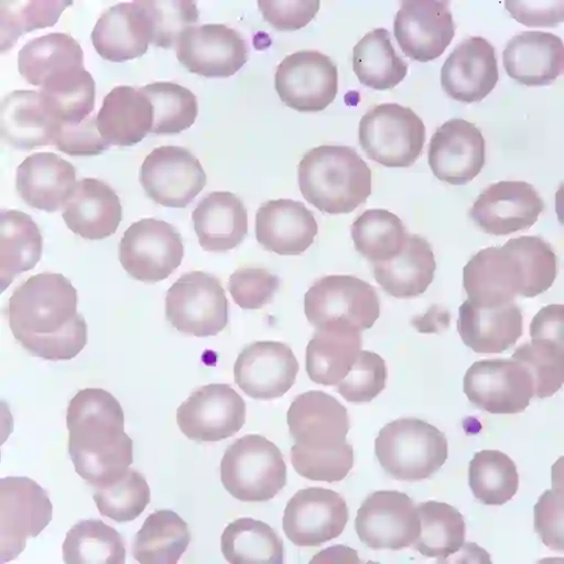 贫血病人红细胞的显微镜视图