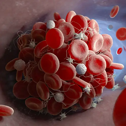 blood clot