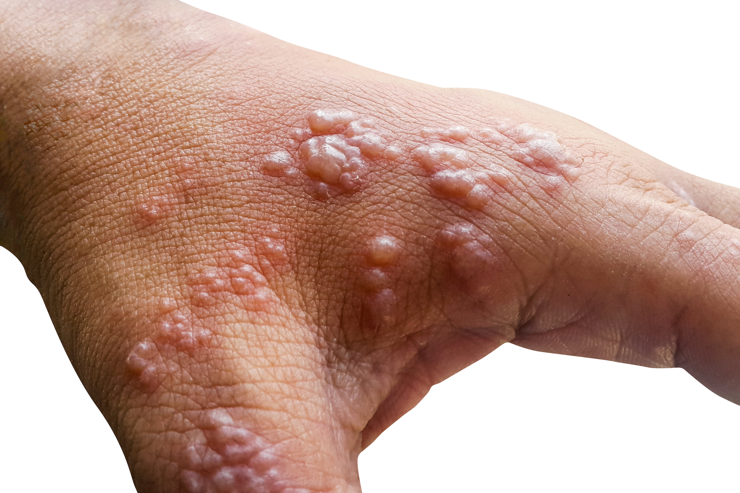 Shingles Symptoms, Causes, Treatments and Prevention