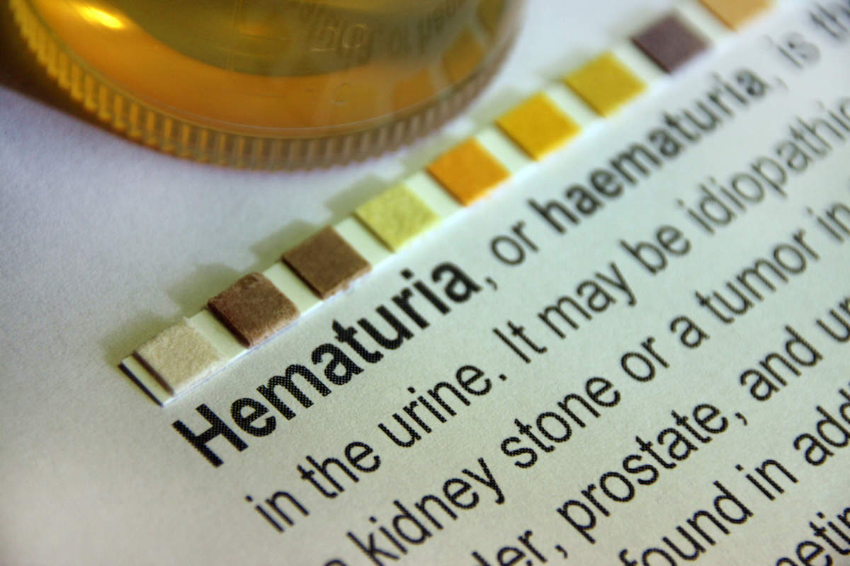 Blood In Urine Signs Causes And Treatments