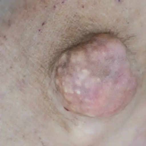 Tophi on the foot of a gout patient.