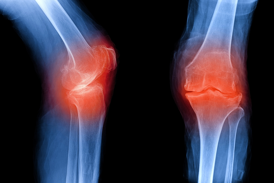 rheumatoid arthritis radiology knee