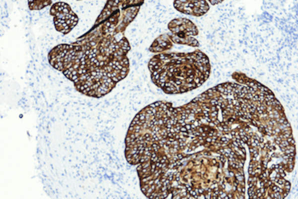 显微镜下的鳞状细胞癌。