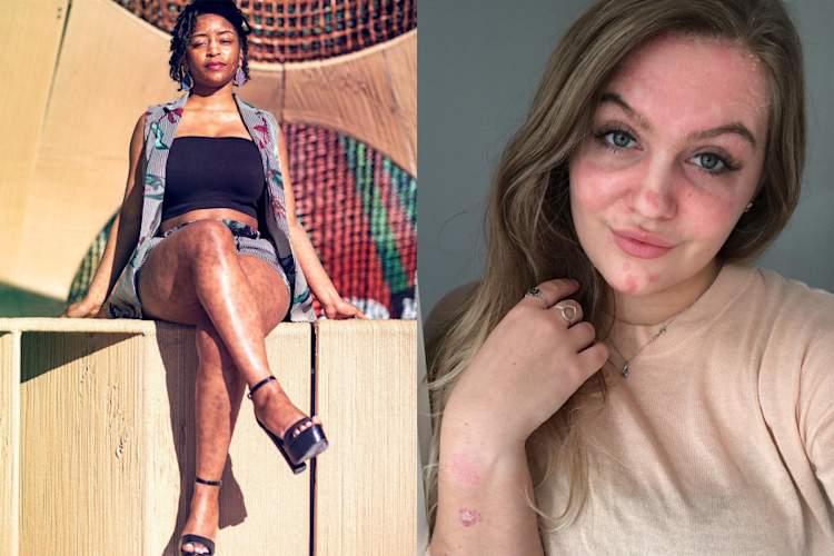 @spottietoohottie_和@thegirlwithpsoriasis