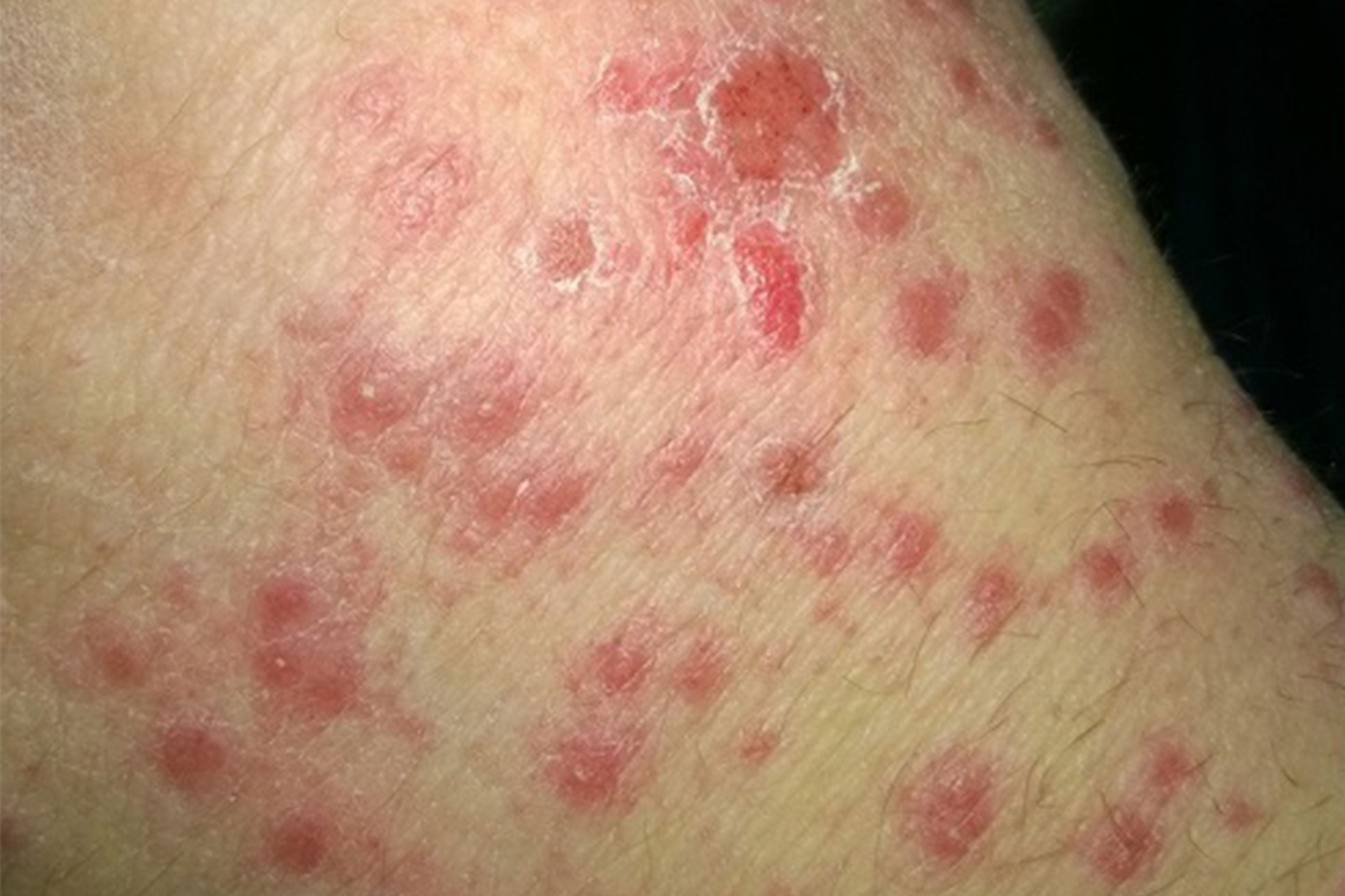 Plaque Psoriasis: What It Looks Like, Causes & Treatment