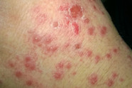 Psoriasis Pityriasis Rosea Symptoms And Causes 56 OFF
