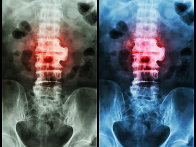 脊椎X光片呈彩色突出，伴有强直性脊柱炎。