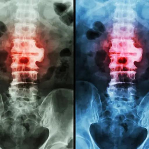强直性脊柱炎患者的x光片彩色突出显示。