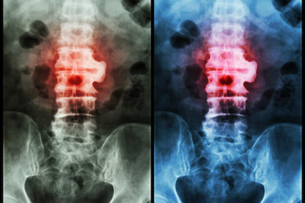 脊椎X光片呈彩色突出,伴有强直性脊柱炎。