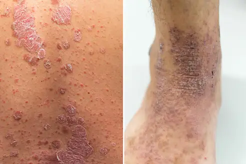Psoriasis vs eczema