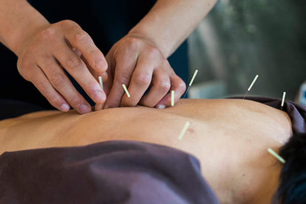针灸治疗。