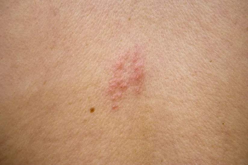带状疱疹在背部起疹子