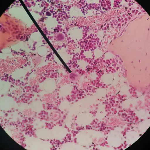 显微镜下PAP涂抹细胞