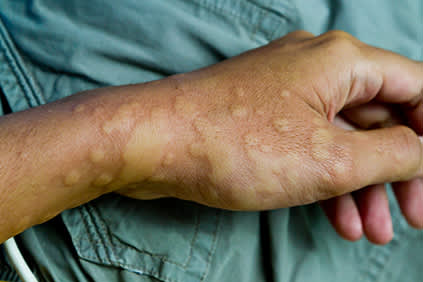 麻疹爆发的一只手。