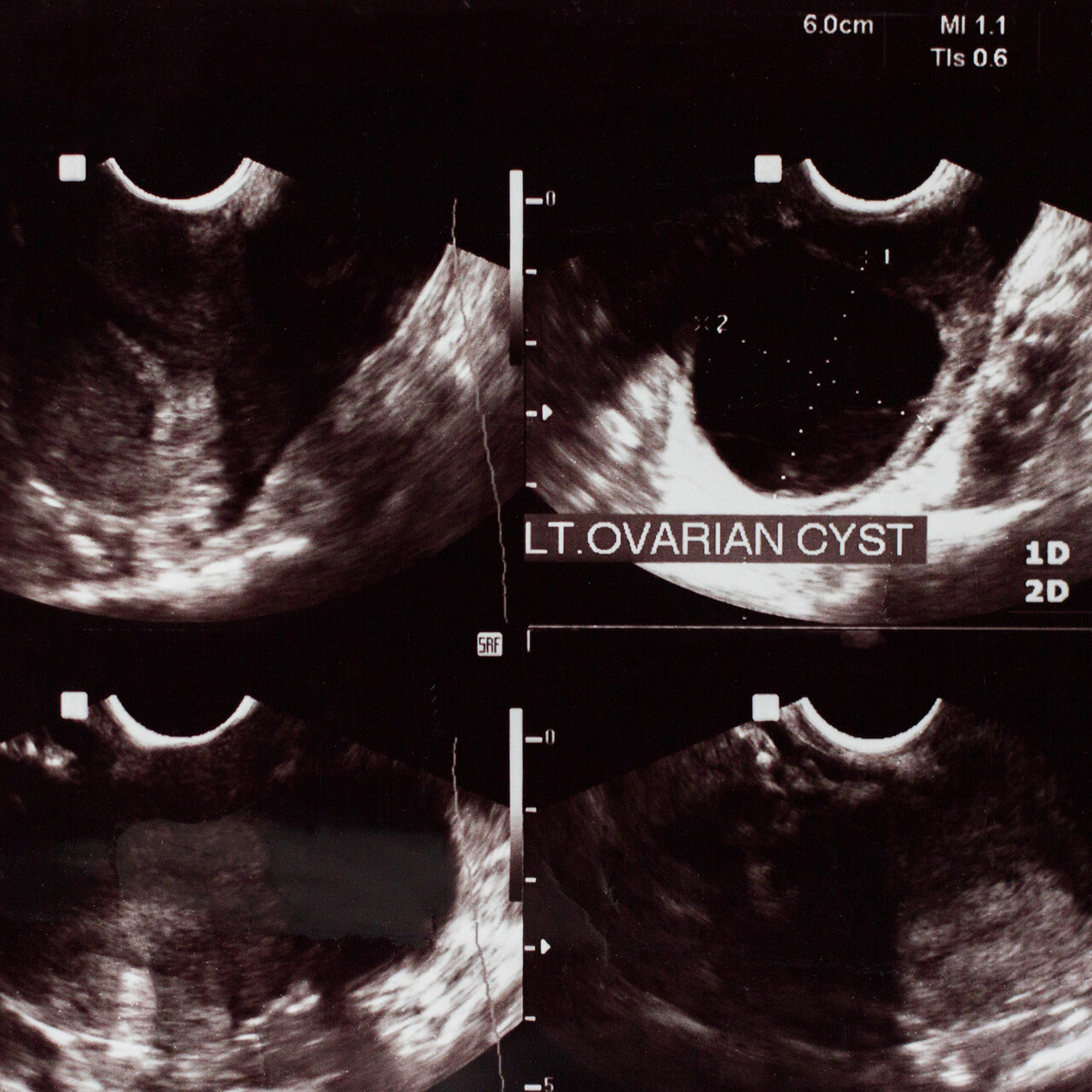 超声检查显示卵巢囊肿