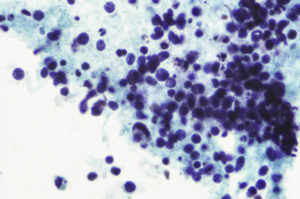 小细胞肺癌的Micrograh
